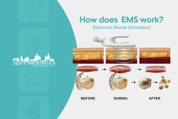 EMS treatment for post pregnancy weight loss treatment Littlehampton
