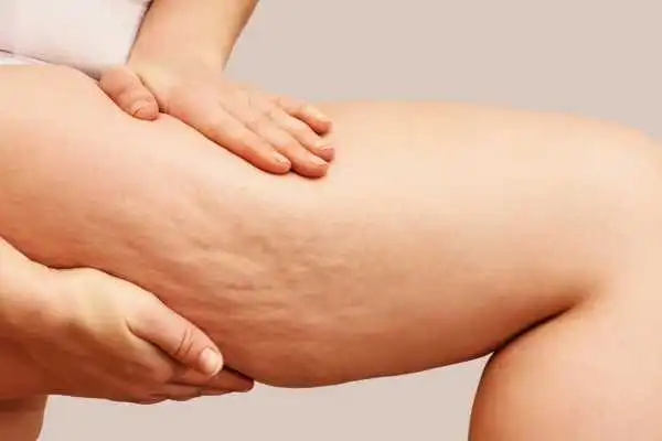 Image of woman showing leg with cellulite Littlehampton
