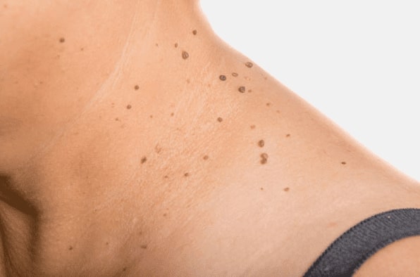 Are you looking for easy skin tag removal Littlehampton - then contact Spire today!