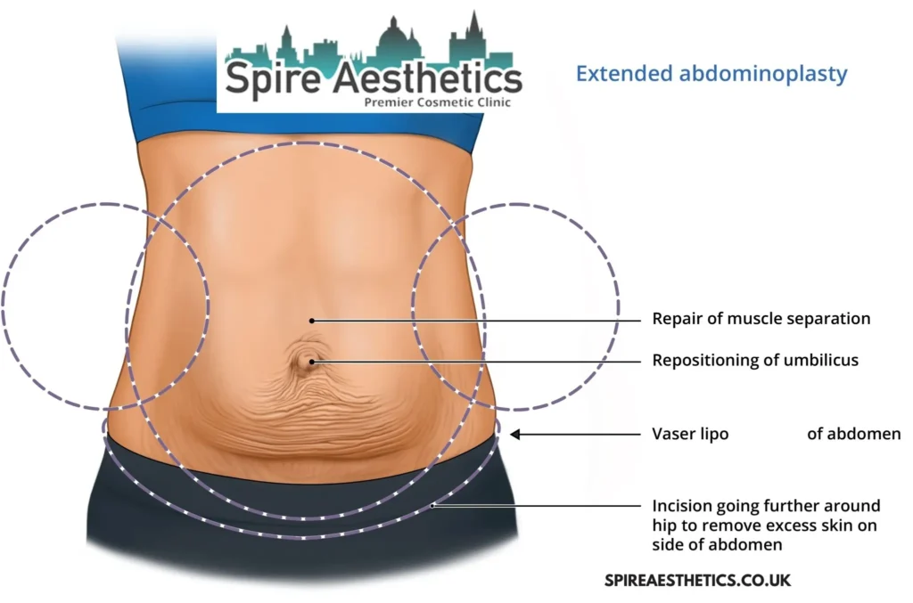 Understanding Loose Skin After Gastric Band Littlehampton Surgery and HIFU Treatment