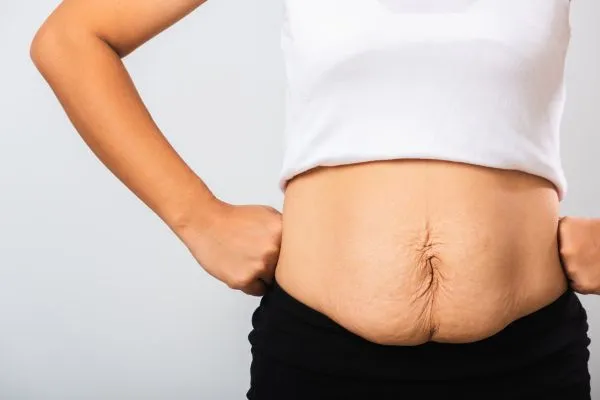 Image of a woman's stomach after weight loss with sagging skin following a gastric band Littlehampton
