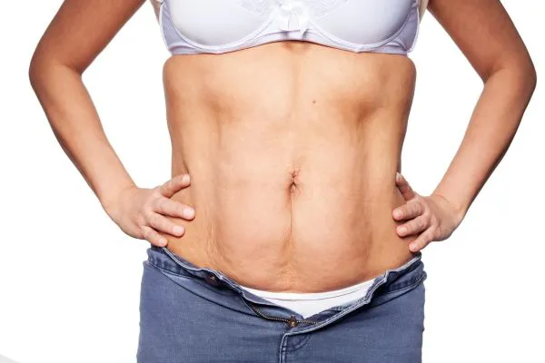 sagging skin on woman's stomach after weight loss injections Littlehampton