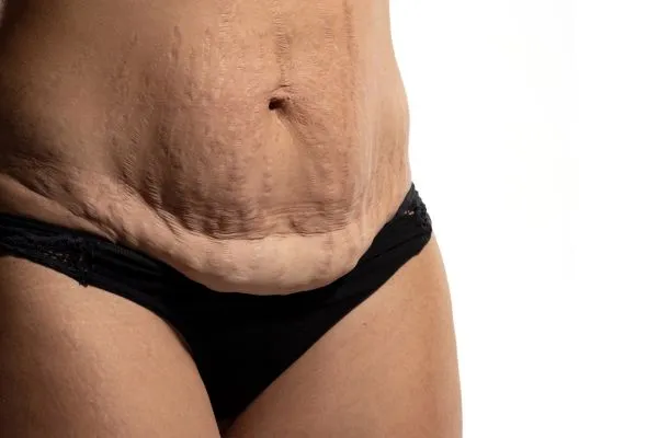 Image of womans stomach after weight loss injections Littlehampton showing saggy skin