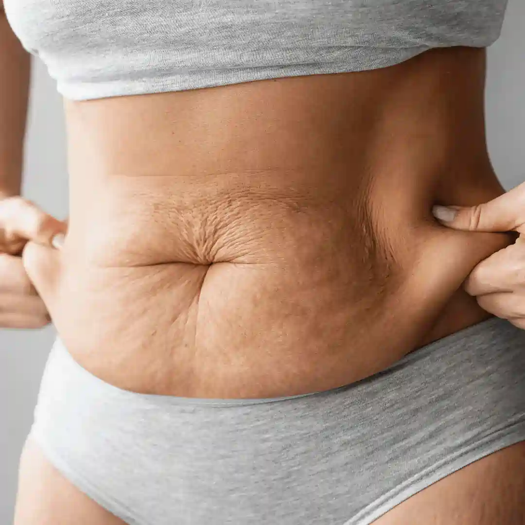 Is It Normal to Have Loose Skin After Pregnancy Littlehampton?